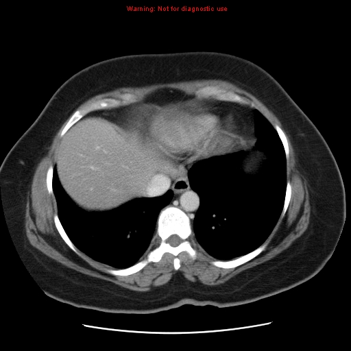 Acute appendicitis complicated by ovarian vein thrombophlebitis (Radiopaedia 16172-15851 Axial C+ portal venous phase 16).jpg