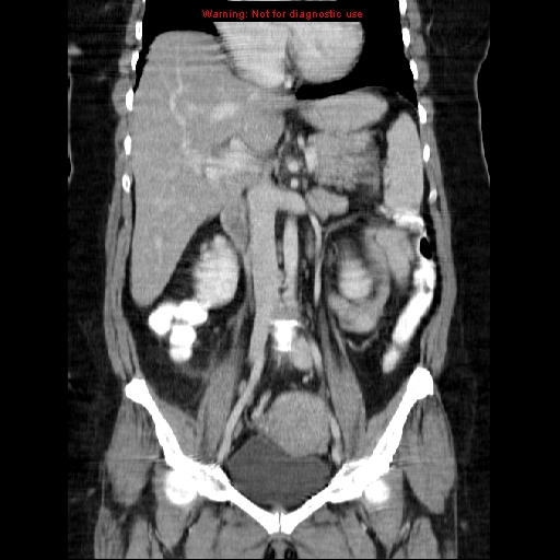 Acute appendicitis complicated by ovarian vein thrombophlebitis (Radiopaedia 16172-15851 Coronal C+ portal venous phase 42).jpg