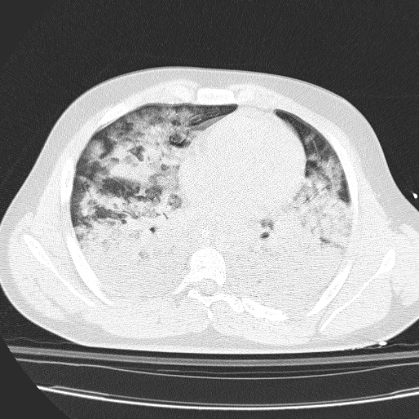 Acute aspiration pneumonitis (Radiopaedia 33605-34703 Axial lung window 56).jpg