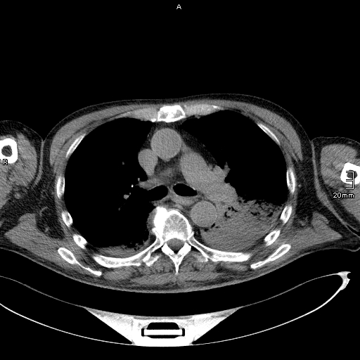 Acute aspiration pneumonitis (Radiopaedia 55642-62166 Axial liver window 27).jpg