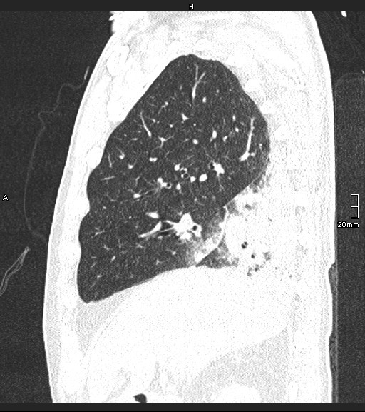 Acute aspiration pneumonitis (Radiopaedia 55642-62166 Sagittal lung window 108).jpg
