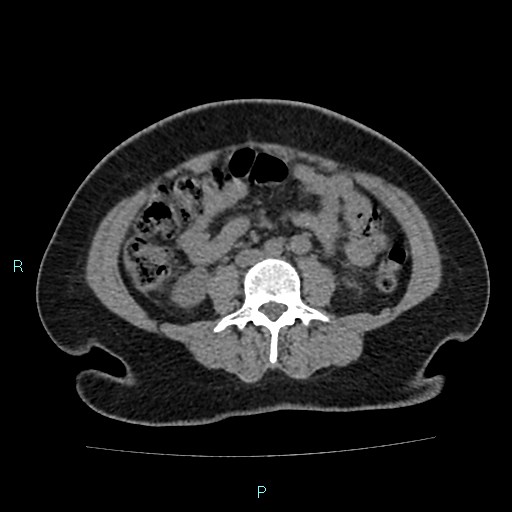 Acute bilateral pyelonephritis (Radiopaedia 37146-38881 Axial non-contrast 59).jpg