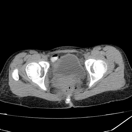Acute bilateral pyelonephritis (Radiopaedia 74153-84969 Axial non-contrast 48).jpg