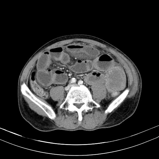 Acute bowel ischemia (Radiopaedia 87695-104114 Axial C+ portal venous phase 56).jpg