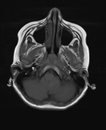 File:Acute cerebellar ataxia (Radiopaedia 61487-69446 Axial T1 3).jpg