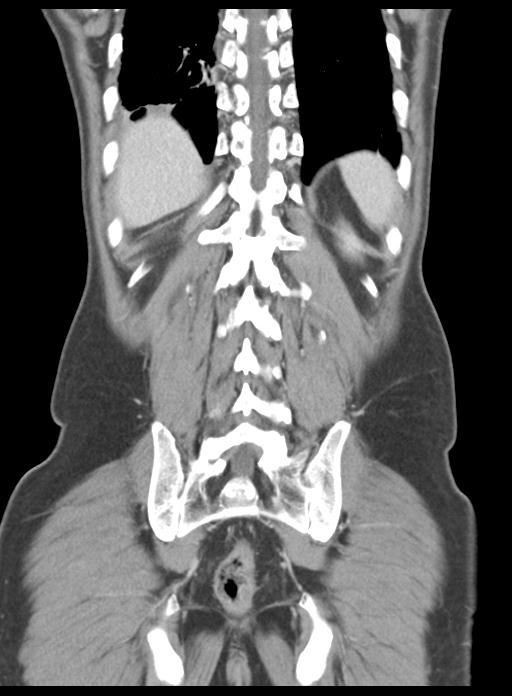 Acute cholecystitis (Radiopaedia 29814-30327 Coronal C+ portal venous phase 42).jpg