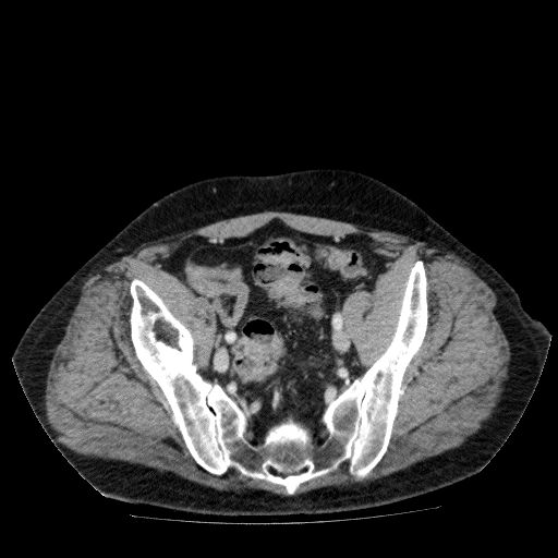 File:Acute cholecystitis and incidental left sided IVC (Radiopaedia 49352-54459 Axial C+ portal venous phase 126).jpg