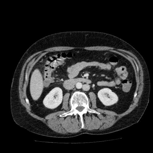Acute cholecystitis and incidental left sided IVC (Radiopaedia 49352-54459 Axial C+ portal venous phase 75).jpg