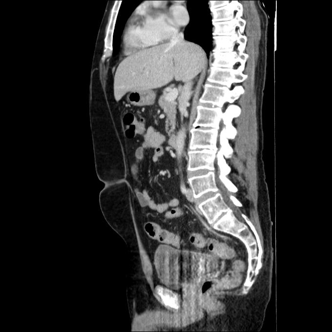 Acute cholecystitis and incidental left sided IVC (Radiopaedia 49352-54459 Sagittal C+ portal venous phase 49).jpg
