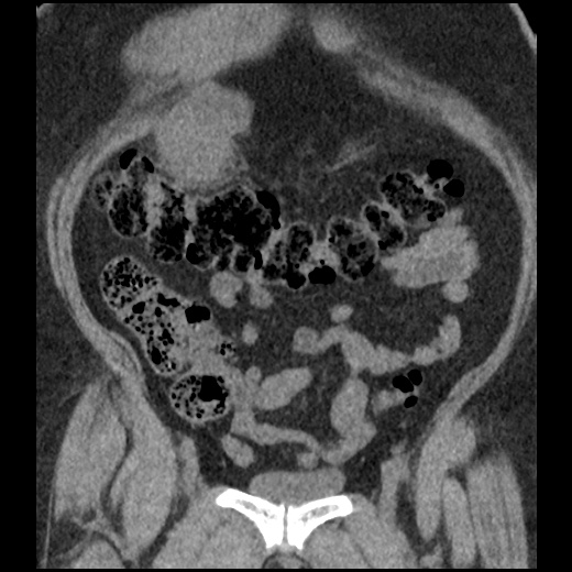File:Acute cholecystitis and ureteric colic (Radiopaedia 42330-45444 Coronal prone 32).jpg