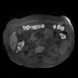 Acute cholecystitis complicated by pylephlebitis (Radiopaedia 65782-74915 Axial T1 fat sat 70).jpg