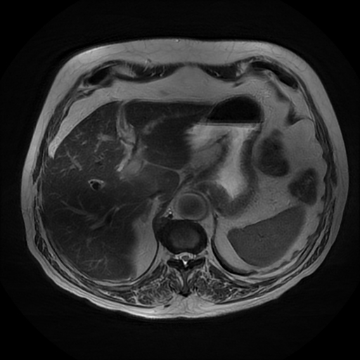 File:Acute cholecystitis complicated by pylephlebitis (Radiopaedia 65782-74915 Axial T2 12).jpg