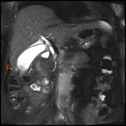 File:Acute cholecystitis with gallbladder neck calculus (Radiopaedia 42795-45971 Coronal T2 Half-fourier-acquired single-shot turbo spin echo (HASTE) 5).jpg