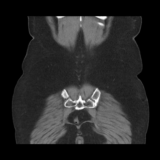File:Acute cholecystitis with tensile fundus sign (Radiopaedia 71394-81723 Coronal non-contrast 105).jpg