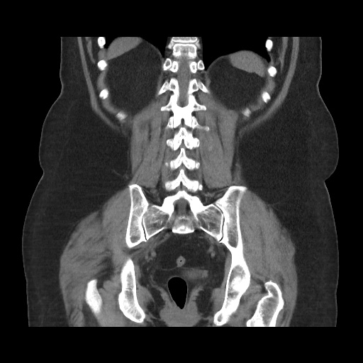 Acute cholecystitis with tensile fundus sign (Radiopaedia 71394-81723 Coronal non-contrast 91).jpg