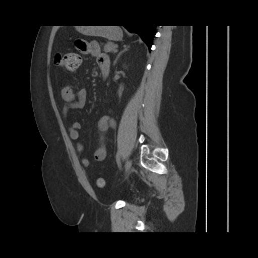 Acute cholecystitis with tensile fundus sign (Radiopaedia 71394-81723 Sagittal non-contrast 106).jpg