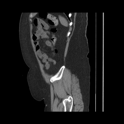 Acute cholecystitis with tensile fundus sign (Radiopaedia 71394-81723 Sagittal non-contrast 137).jpg