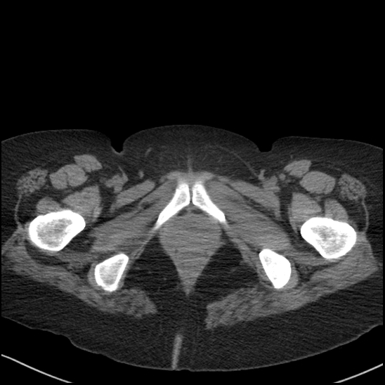 Acute colonic hemorrhage in ulcerative colitis (Radiopaedia 77415-89538 Axial non-contrast 142).jpg