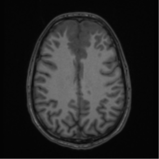 Acute disseminated encephalomyelitis (ADEM) (Radiopaedia 65319-74349 Axial T1 45).png