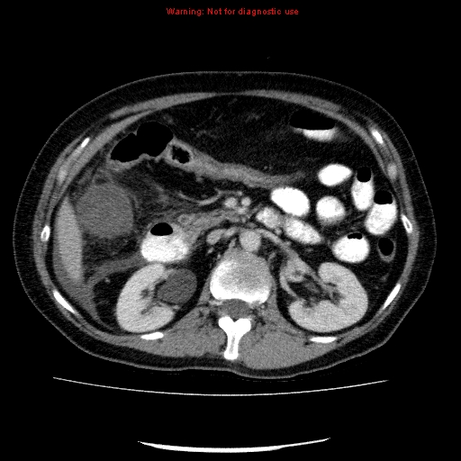 Acute gangrenous cholecystitis (Radiopaedia 10123-10661 Axial C+ portal venous phase 40).jpg