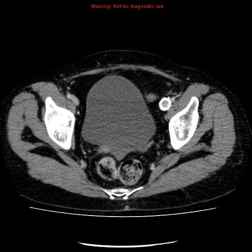 Acute gangrenous cholecystitis (Radiopaedia 10123-10661 Axial C+ portal venous phase 91).jpg