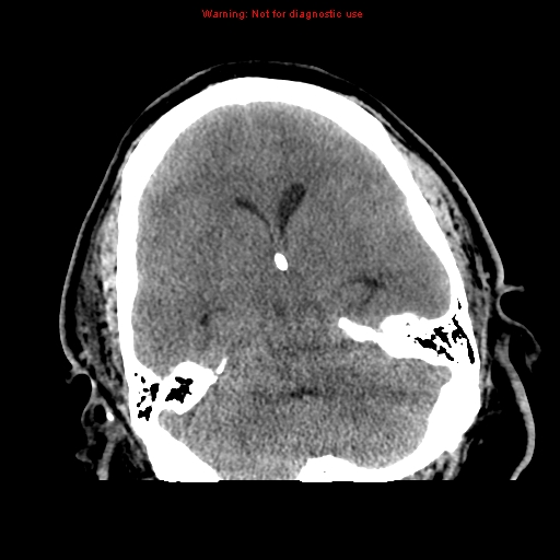 File:Acute hemorrhagic leukoencephalitis (Radiopaedia 14076-72275 Axial non-contrast 13).jpg
