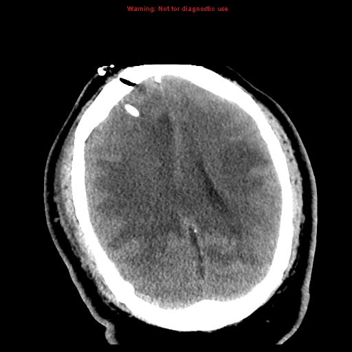 File:Acute hemorrhagic leukoencephalitis (Radiopaedia 14076-72275 Axial non-contrast 26).jpg