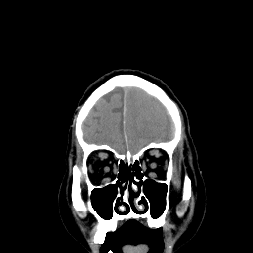 File:Acute hemorrhagic stroke (Radiopaedia 17507-17223 Coronal non-contrast 8).jpg