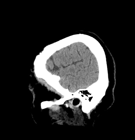 Acute internal carotid artery dissection (Radiopaedia 53541-59558 Sagittal non-contrast 8).jpg