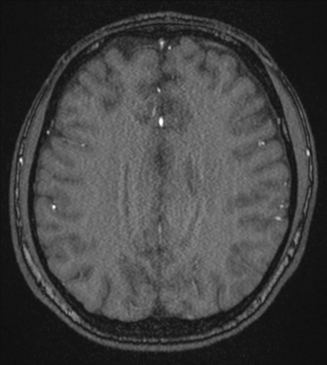 Acute left middle cerebral artery territory infarct with clot retrieval (Radiopaedia 47732-52433 Axial MRA 44).png