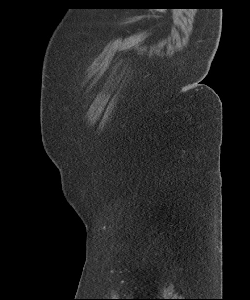 Acute mesenteric venous ischemia (Radiopaedia 46041-50383 Sagittal C+ portal venous phase 118).jpg