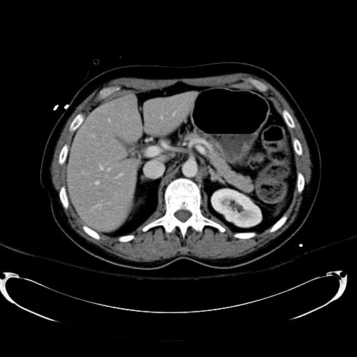 File:Acute myocardial infarction in CT (Radiopaedia 39947-42415 Axial C+ portal venous phase 39).jpg