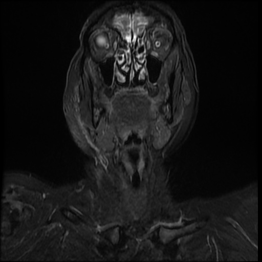 File:Acute otitis externa (Radiopaedia 57296-64236 Coronal STIR 4).jpg