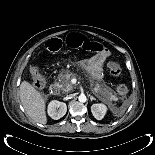Acute pancreatic necrosis (Radiopaedia 13560-18500 Axial C+ portal venous phase 57).jpg