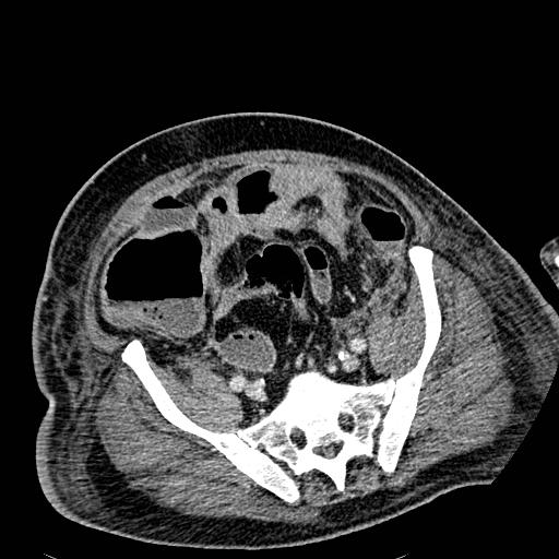 Acute pancreatic necrosis (Radiopaedia 13560-18501 Axial C+ portal venous phase 112).jpg
