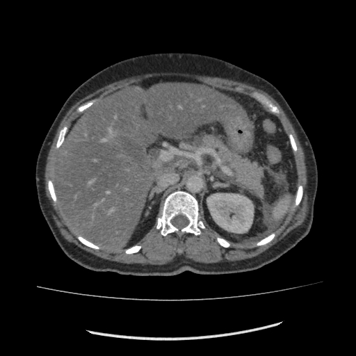 Acute pancreatitis (Radiopaedia 80007-93285 Axial C+ portal venous phase 44).jpg