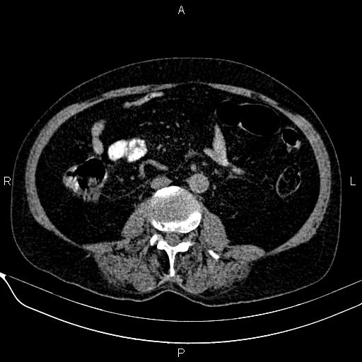 Acute pancreatitis (Radiopaedia 85146-100701 Axial non-contrast 70).jpg