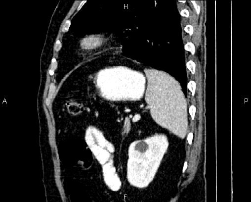 File:Acute pancreatitis (Radiopaedia 85146-100701 Sagittal C+ portal venous phase 75).jpg