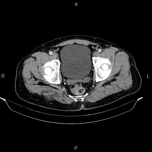 File:Acute pancreatitis (Radiopaedia 85390-101010 Axial C+ portal venous phase 101).jpg