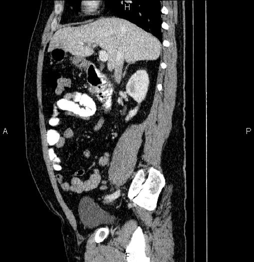 File:Acute pancreatitis (Radiopaedia 85390-101010 Sagittal C+ portal venous phase 36).jpg