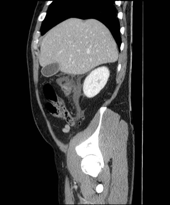 Acute pancreatitis - Balthazar E (Radiopaedia 23080-23110 Sagittal C+ portal venous phase 18).jpg