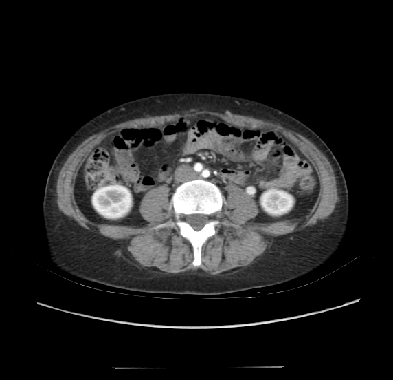 File:Acute pancreatitis - Balthazar E - post ERCP (Radiopaedia 27562-27772 Axial C+ arterial phase 36).png