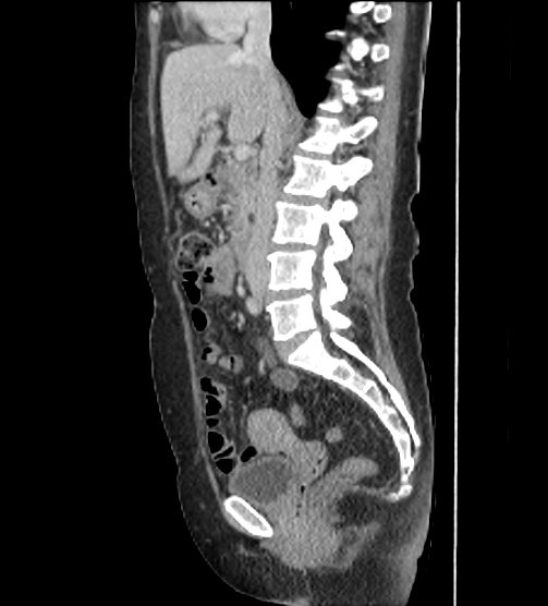 File:Acute pancreatitis - Balthazar E - post ERCP (Radiopaedia 27562-27772 Sagittal C+ portal venous phase 60).png