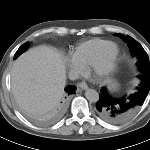 File:Acute pancreatitis and walled-off necrosis (Radiopaedia 29888-30403 Axial non-contrast 5).jpg