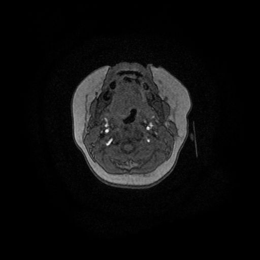 Acute phase of hemiconvulsion-hemiplegia epilepsy syndrome (Radiopaedia 29309-29745 Axial TOF angiography 177).jpg