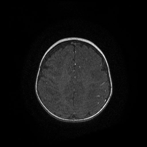 Acute phase of hemiconvulsion-hemiplegia epilepsy syndrome (Radiopaedia 29309-29745 Axial TOF angiography 6).jpg