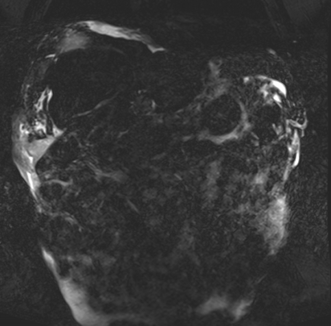 Acute portal vein thrombosis (Radiopaedia 73198-83925 Coronal Heavily T2 thin cuts 64).jpg