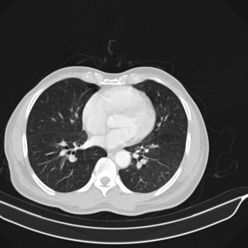 Acute pulmonary embolism (Radiopaedia 69510-79390 Axial lung window 47).jpg