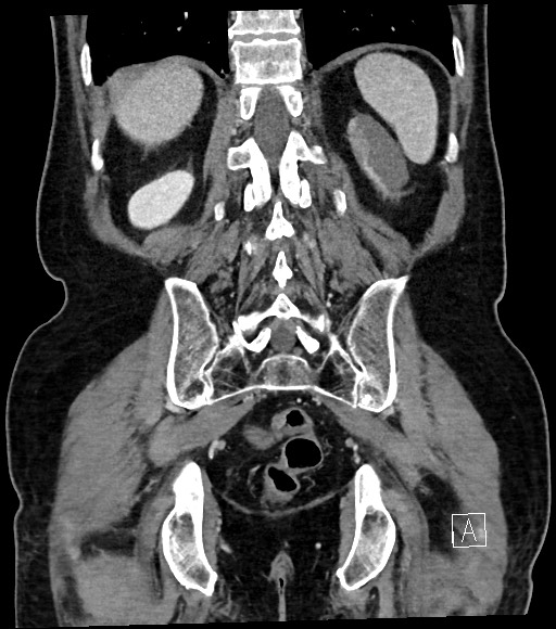 Acute renal infarction (Radiopaedia 59375-66736 Coronal C+ portal venous phase 49).jpg