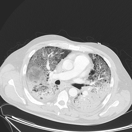 File:Acute respiratory distress syndrome (ARDS) (Radiopaedia 66478-75754 Axial lung window 19).jpg